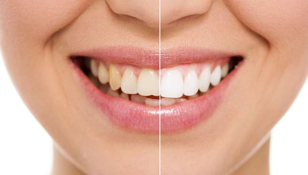 Veneers Vorher Nachher - Beeindruckende Ergebnisse für strahlende Zähne